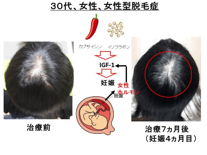 円形脱毛症　病院